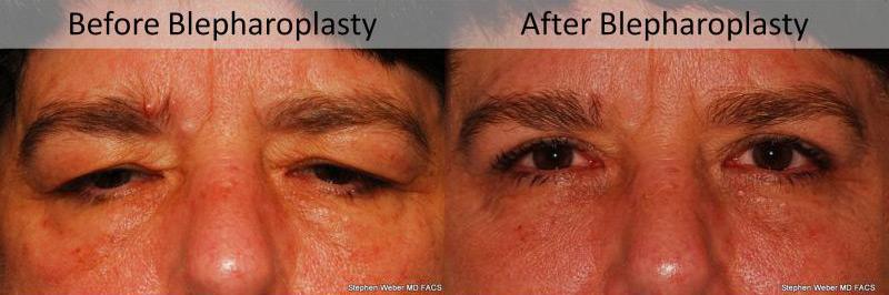 Blepharoplasty Before and After | Weber Facial Plastic Surgery