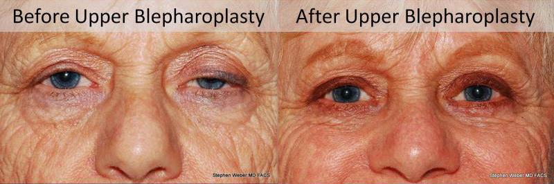 Blepharoplasty Before and After | Weber Facial Plastic Surgery