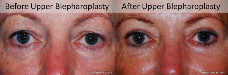 Blepharoplasty Before and After | Weber Facial Plastic Surgery