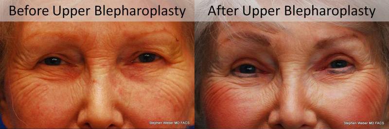 Blepharoplasty Before and After | Weber Facial Plastic Surgery