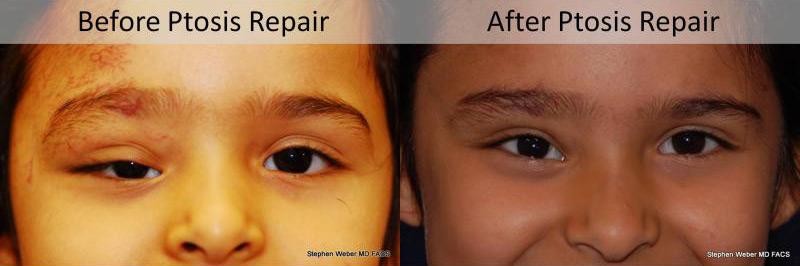 Blepharoplasty Before and After | Weber Facial Plastic Surgery