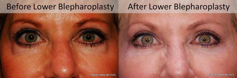 Blepharoplasty Before and After | Weber Facial Plastic Surgery
