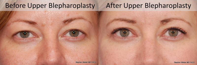Blepharoplasty Before and After | Weber Facial Plastic Surgery