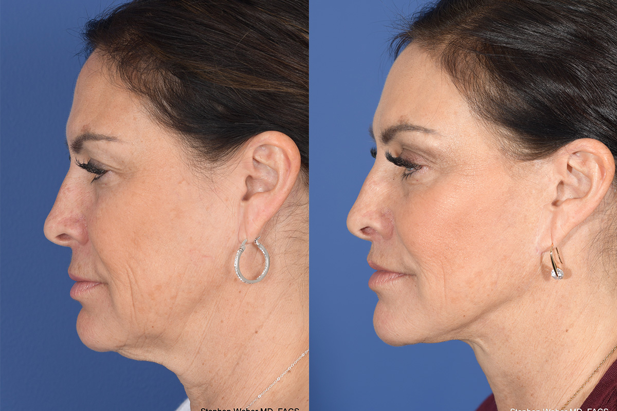 Brow Lift Before and After | Weber Facial Plastic Surgery
