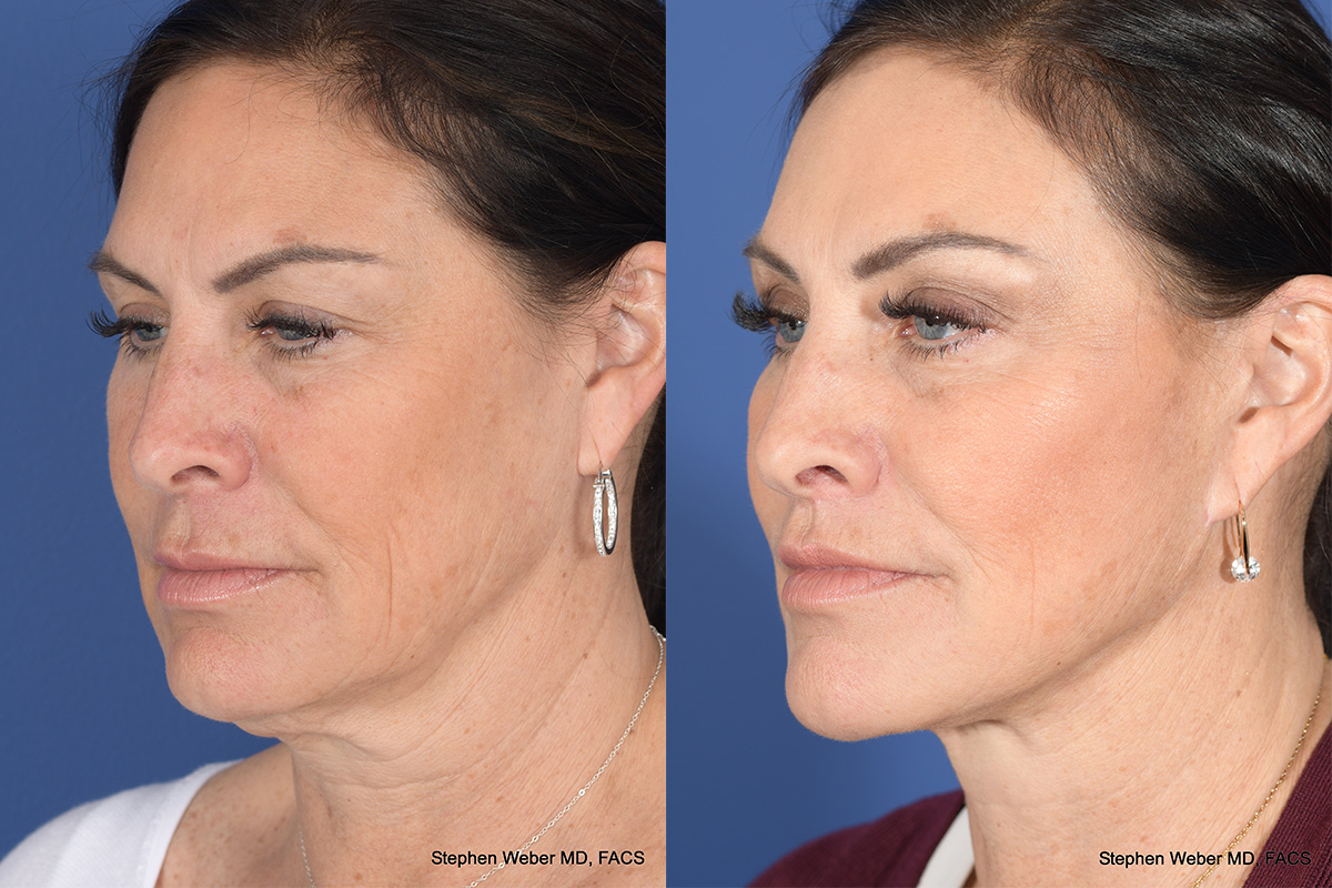 Brow Lift Before and After | Weber Facial Plastic Surgery