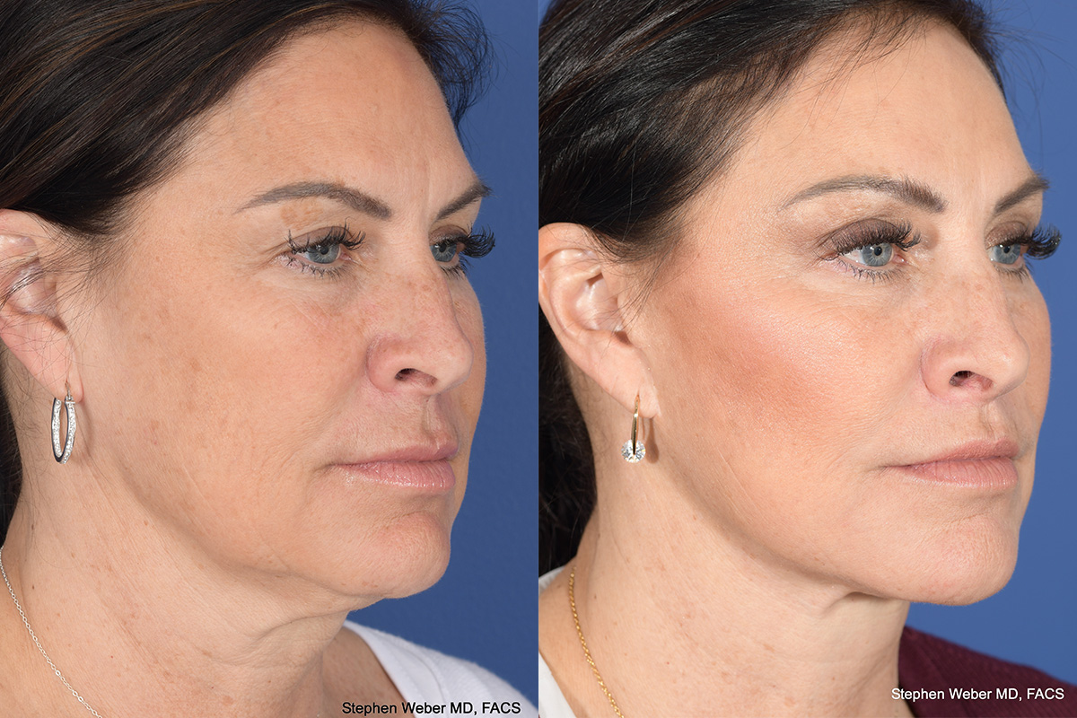 Brow Lift Before and After | Weber Facial Plastic Surgery