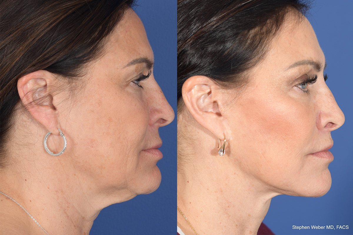 Brow Lift Before and After | Weber Facial Plastic Surgery