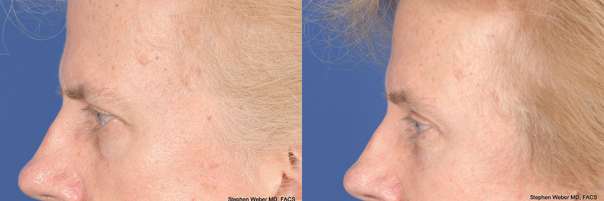 Brow Lift Before and After | Weber Facial Plastic Surgery