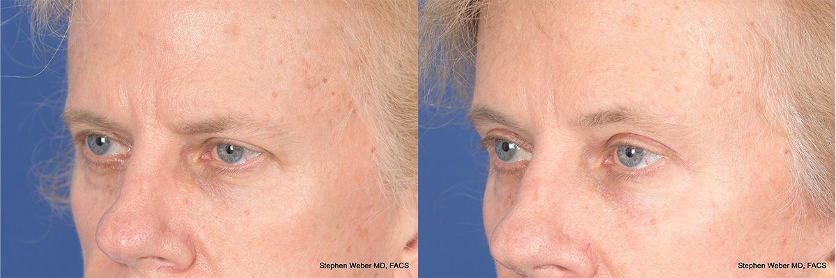 Brow Lift Before and After | Weber Facial Plastic Surgery
