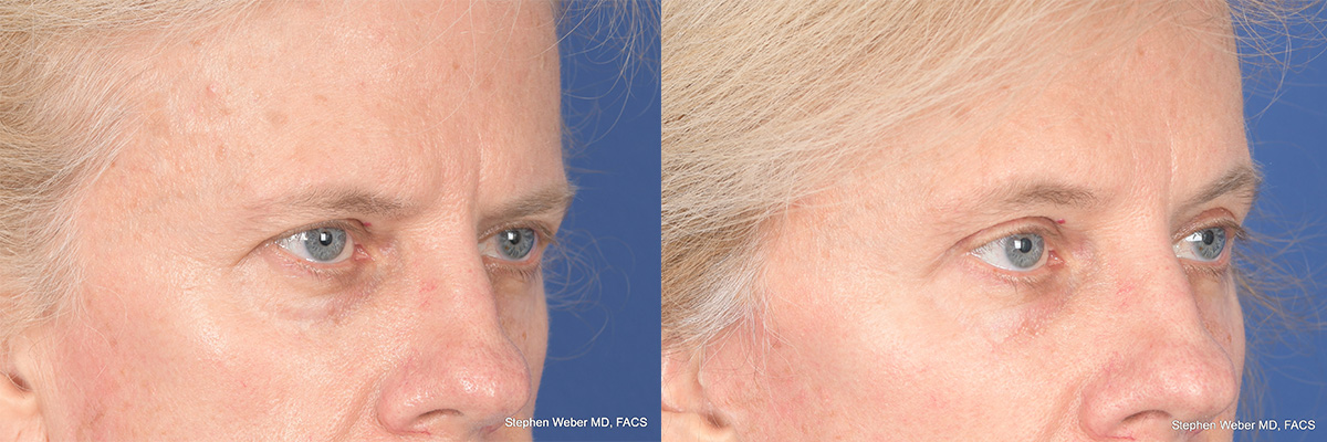 Brow Lift Before and After | Weber Facial Plastic Surgery