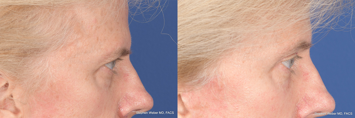 Brow Lift Before and After | Weber Facial Plastic Surgery