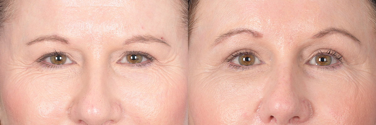 Brow Lift Before and After | Weber Facial Plastic Surgery