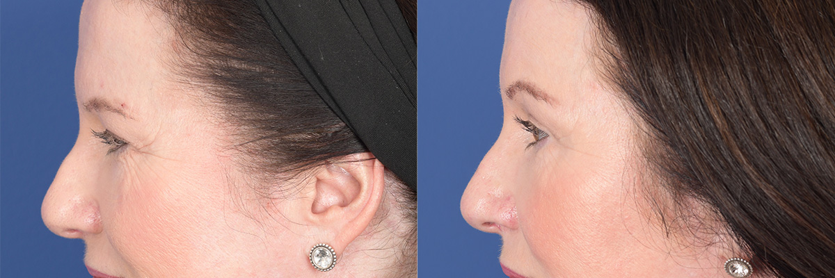 Brow Lift Before and After | Weber Facial Plastic Surgery