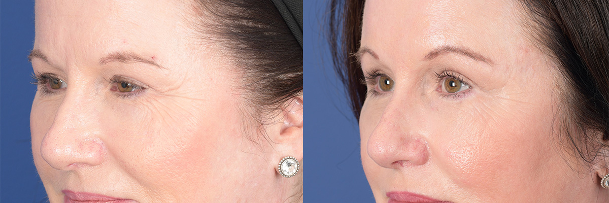 Brow Lift Before and After | Weber Facial Plastic Surgery