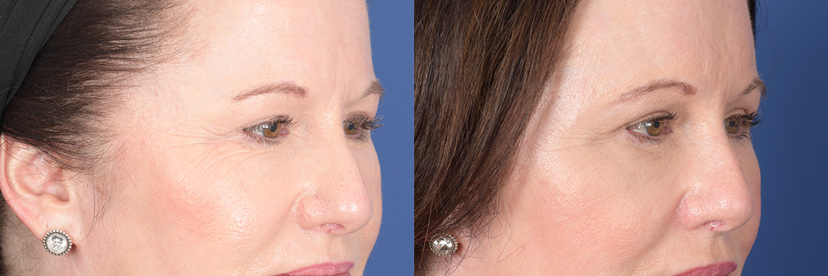 Brow Lift Before and After | Weber Facial Plastic Surgery