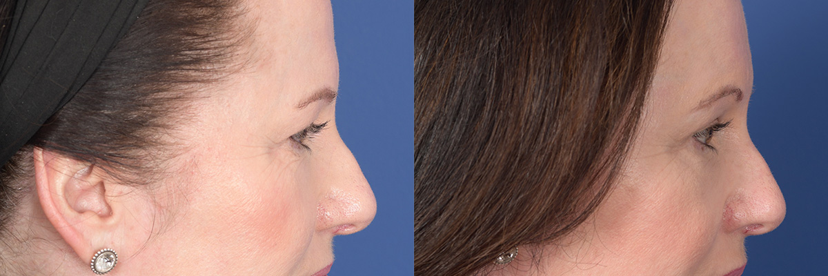 Brow Lift Before and After | Weber Facial Plastic Surgery