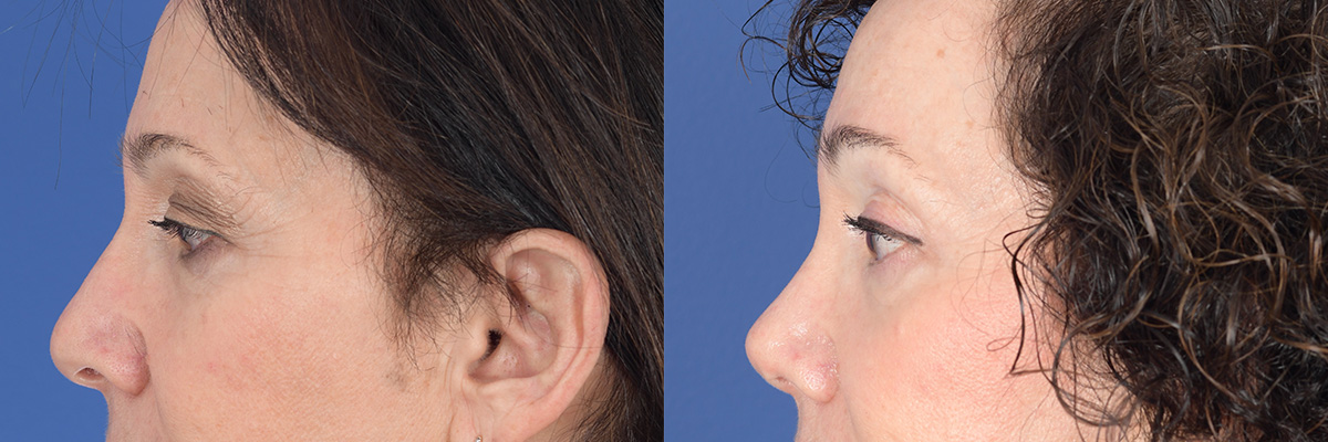 Brow Lift Before and After | Weber Facial Plastic Surgery