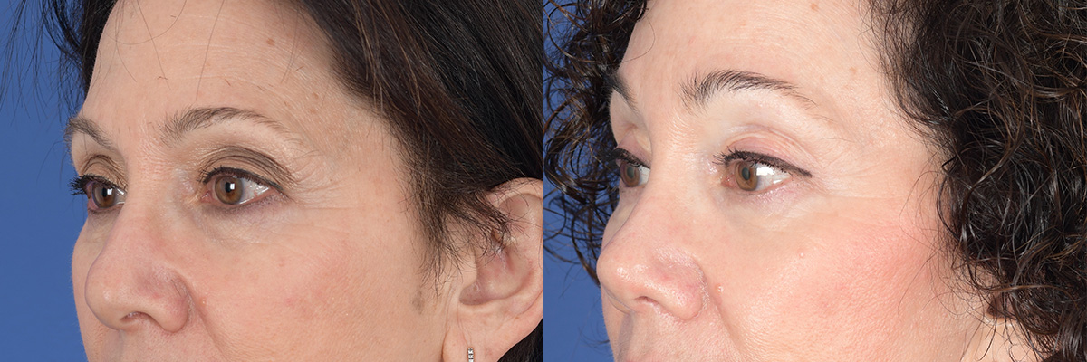 Brow Lift Before and After | Weber Facial Plastic Surgery