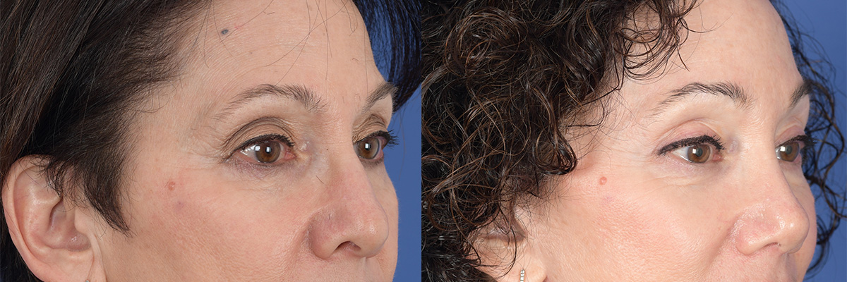 Brow Lift Before and After | Weber Facial Plastic Surgery