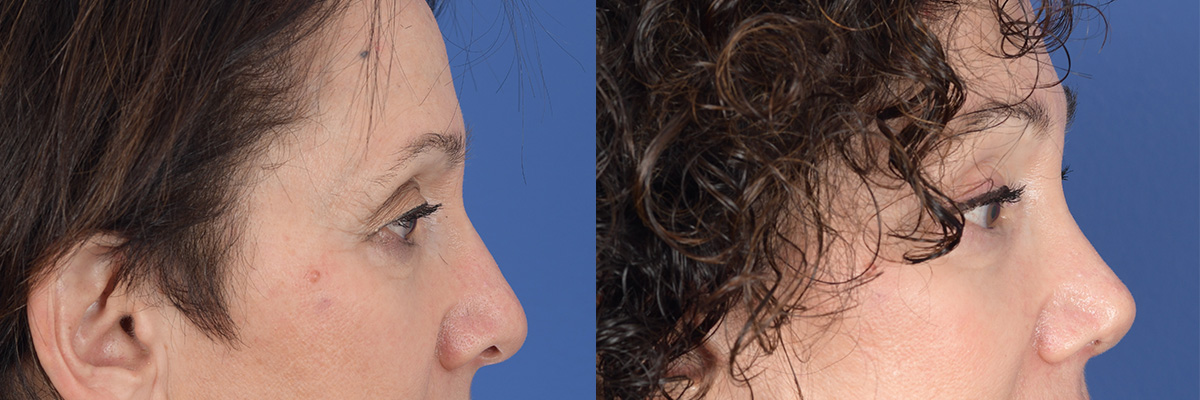Brow Lift Before and After | Weber Facial Plastic Surgery