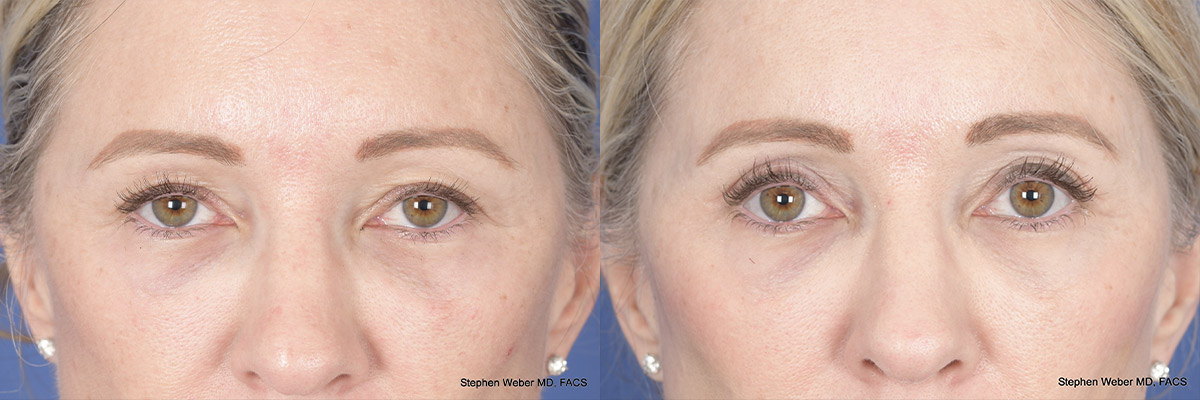 Brow Lift Before and After | Weber Facial Plastic Surgery