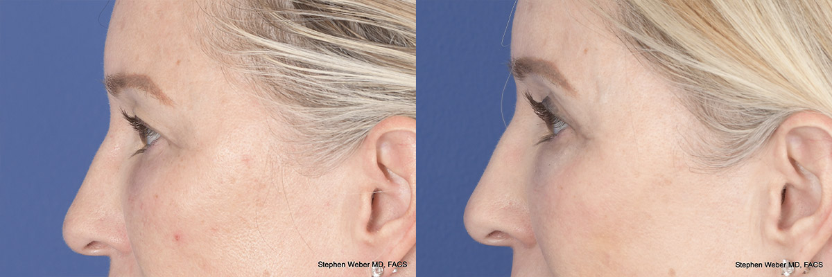 Brow Lift Before and After | Weber Facial Plastic Surgery
