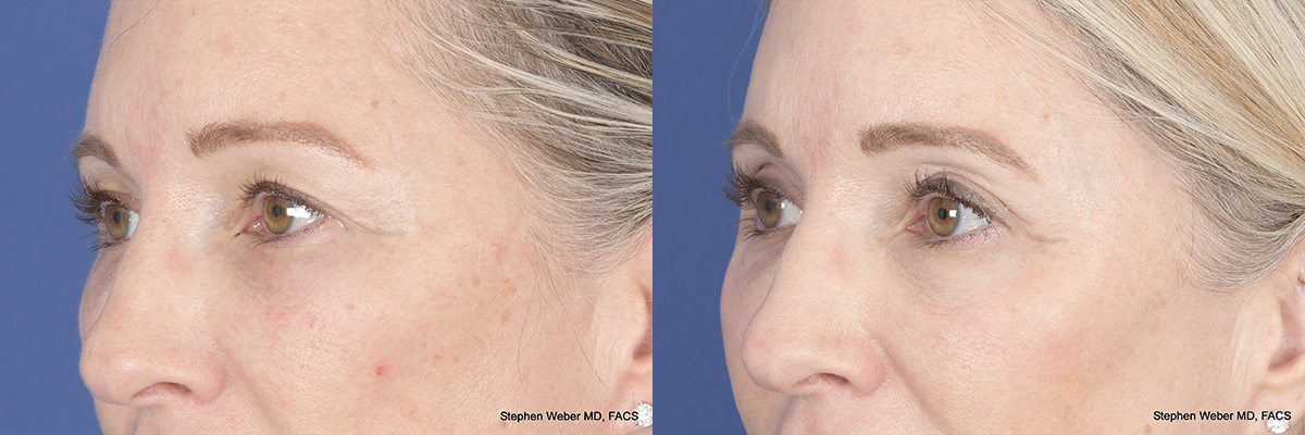 Brow Lift Before and After | Weber Facial Plastic Surgery