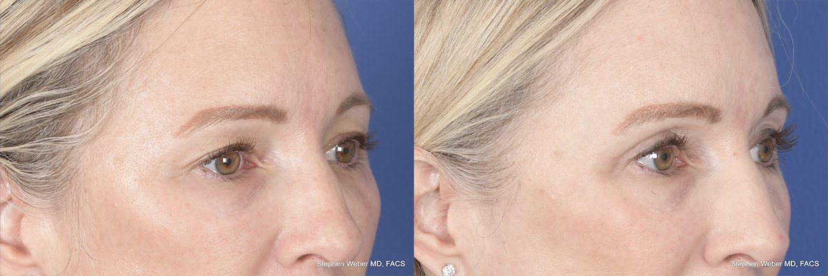Brow Lift Before and After | Weber Facial Plastic Surgery