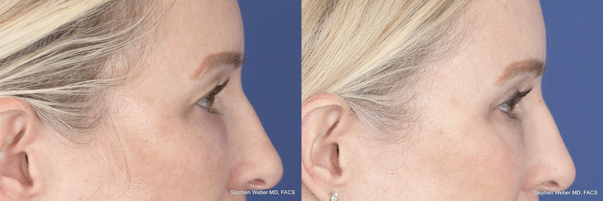 Brow Lift Before and After | Weber Facial Plastic Surgery