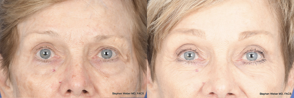 Brow Lift Before and After | Weber Facial Plastic Surgery