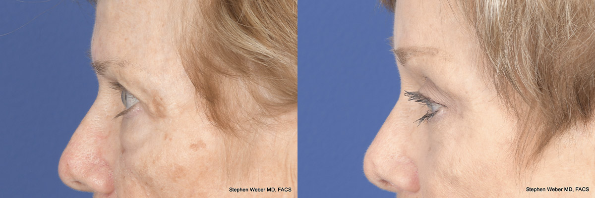 Brow Lift Before and After | Weber Facial Plastic Surgery