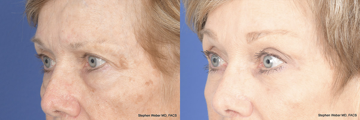 Brow Lift Before and After | Weber Facial Plastic Surgery