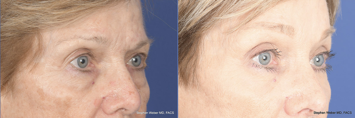Brow Lift Before and After | Weber Facial Plastic Surgery