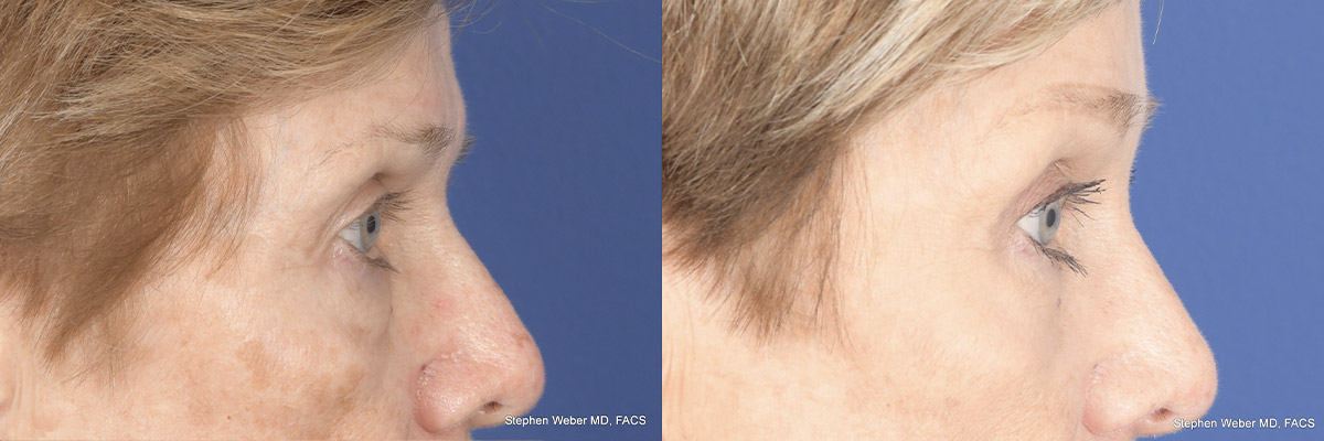 Brow Lift Before and After | Weber Facial Plastic Surgery