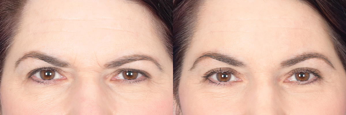 Brow Lift Before and After | Weber Facial Plastic Surgery