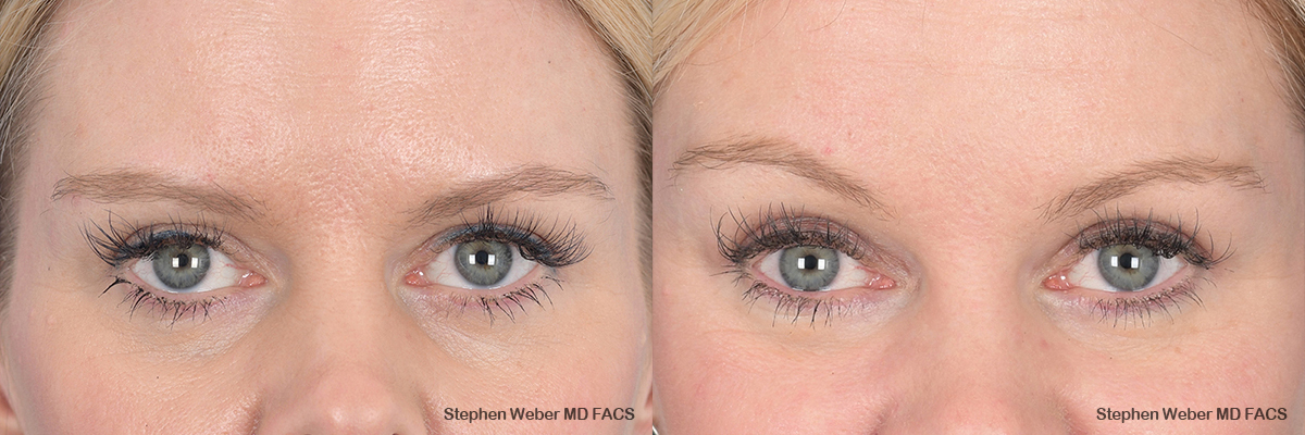 Brow Lift Before and After | Weber Facial Plastic Surgery