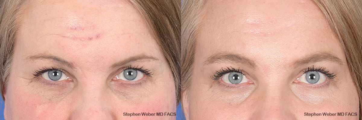 Brow Lift Before and After | Weber Facial Plastic Surgery