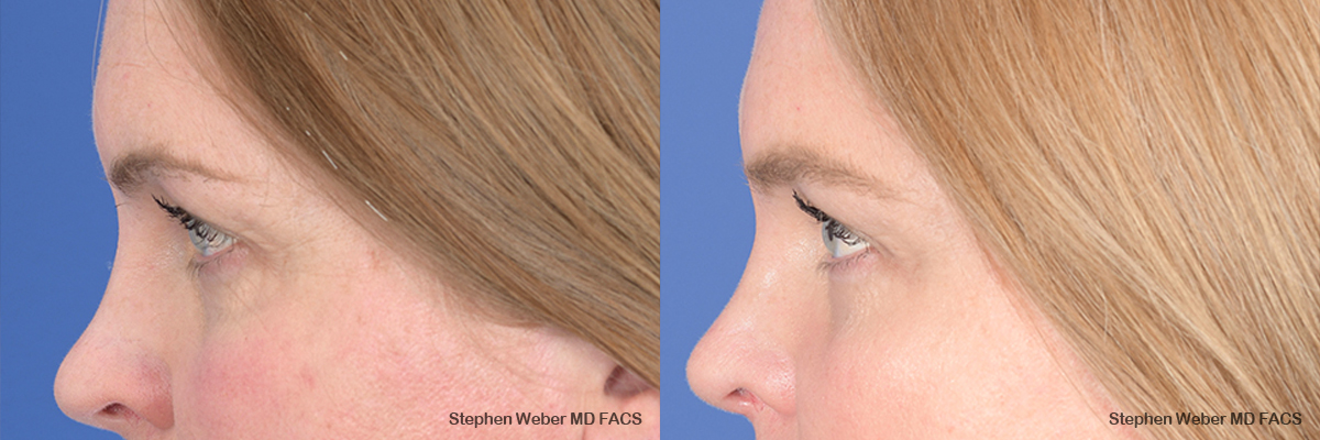 Brow Lift Before and After | Weber Facial Plastic Surgery