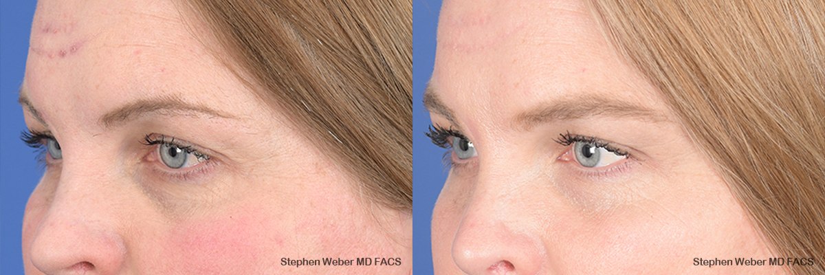 Brow Lift Before and After | Weber Facial Plastic Surgery
