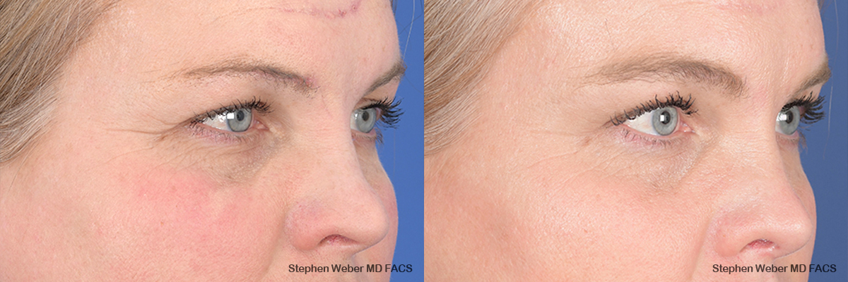 Brow Lift Before and After | Weber Facial Plastic Surgery