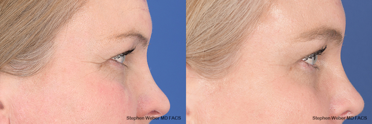 Brow Lift Before and After | Weber Facial Plastic Surgery