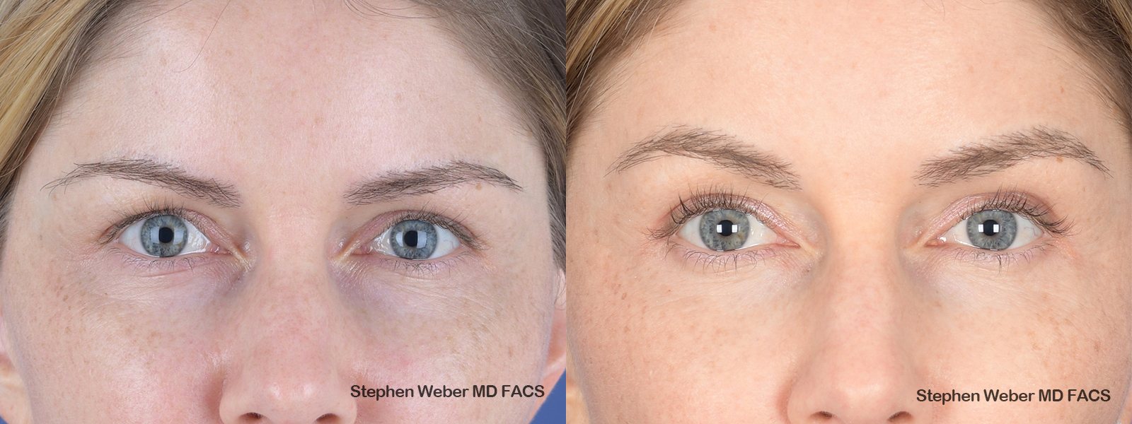 Brow Lift Before and After | Weber Facial Plastic Surgery