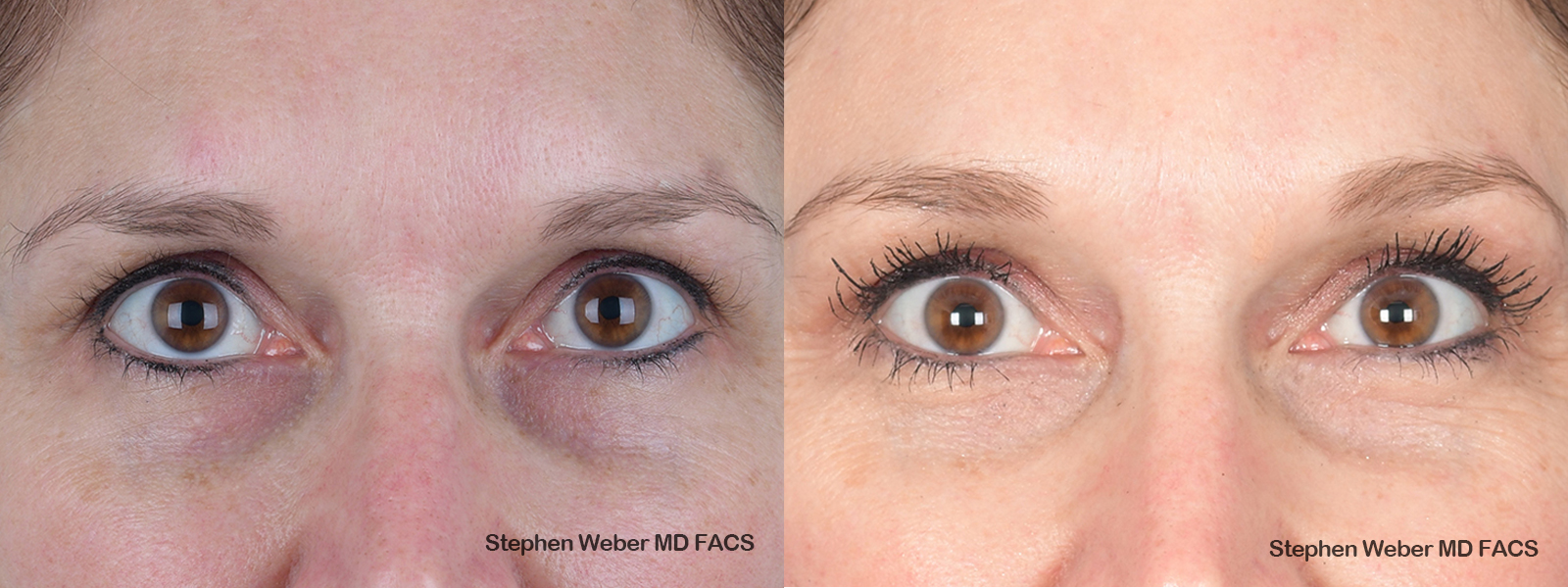 Brow Lift Before and After | Weber Facial Plastic Surgery