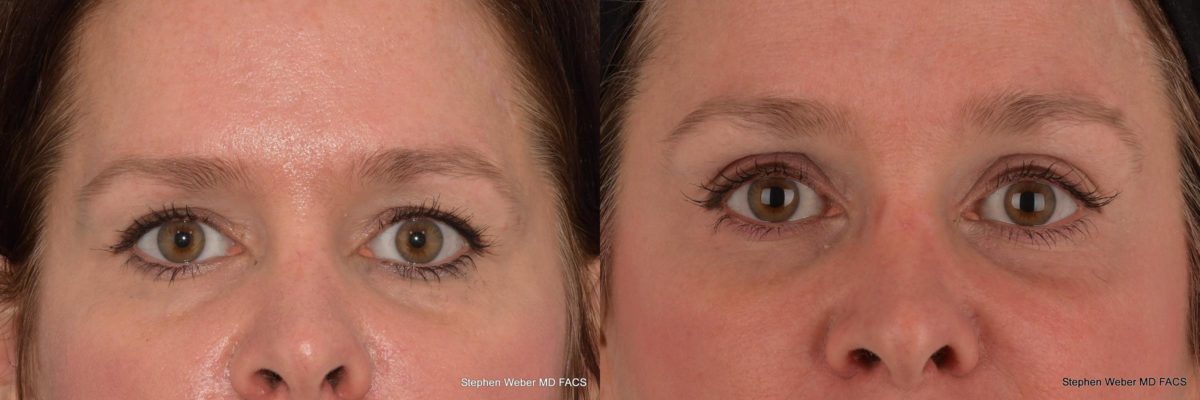 Brow Lift Before and After | Weber Facial Plastic Surgery