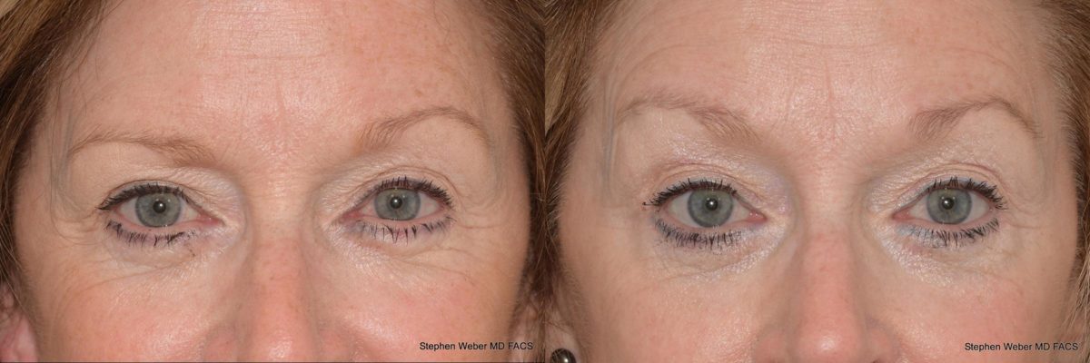 Brow Lift Before and After | Weber Facial Plastic Surgery