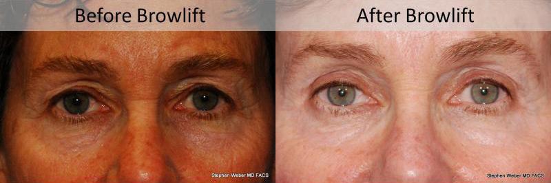 Brow Lift Before and After | Weber Facial Plastic Surgery