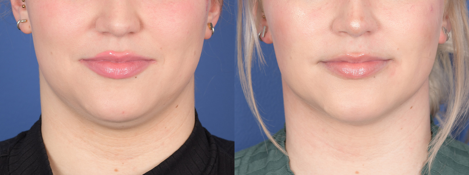 Buccal Fat Pad Removal Before and After 01