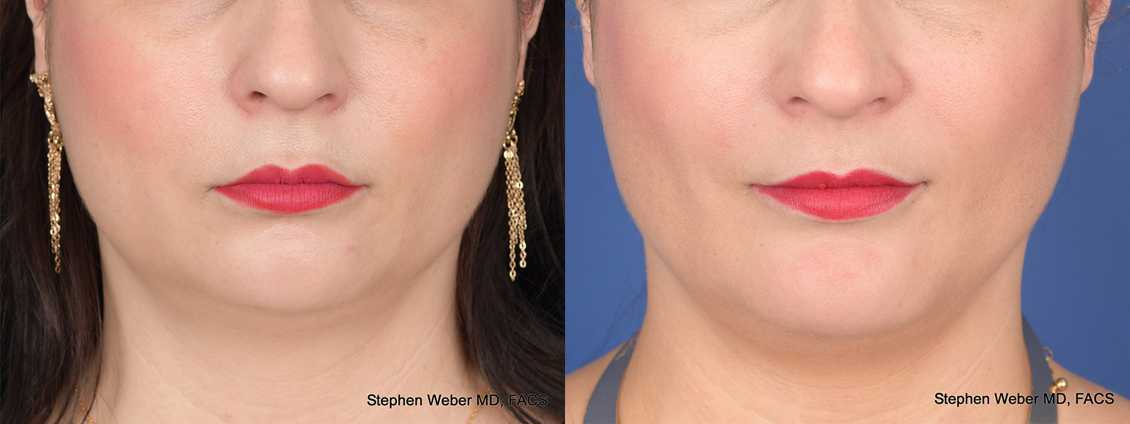Before and After Buccal Fat Removal in Denver 2