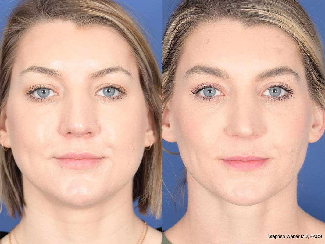 Buccal Fat Pad Removal Before and After | Weber Facial Plastic Surgery