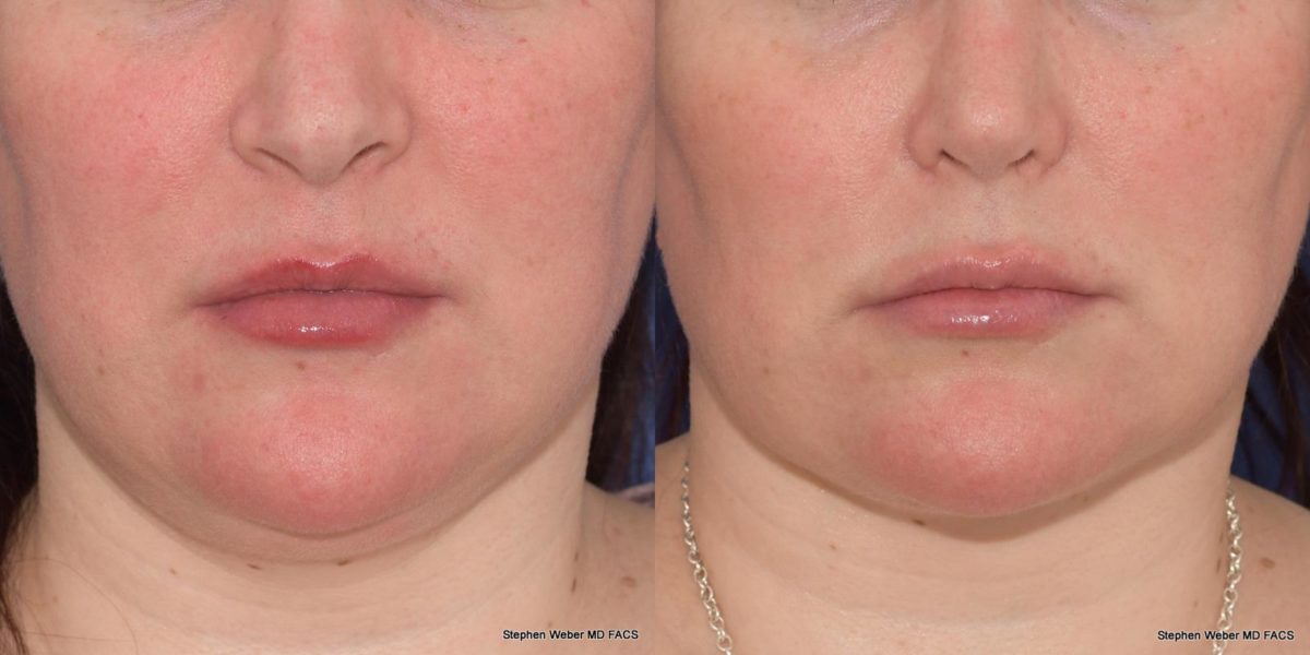 Before and After Buccal Fat Removal in Denver 3
